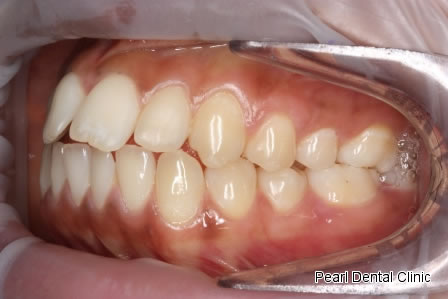 Invisalign Before After - Left full top/bottom arch teeth 
