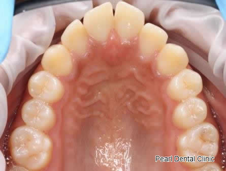 Invisalign Before After - Top arch teeth 