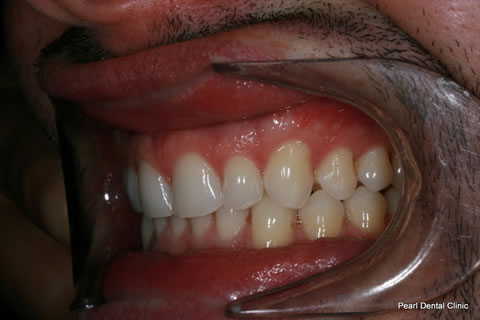 Teeth Invisalign/ Whitening Before After - Left full upper/bottom arch teeth