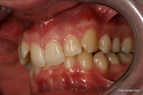 Teeth Invisalign/ Whitening Before After  - Left full arch upper/lower teeth 