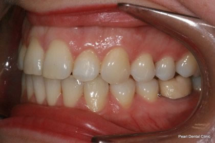 Invisalign Before After  - Left full upper/bottom arch teeth  