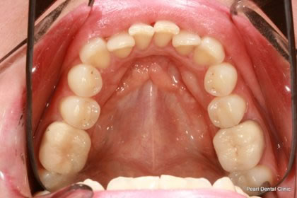 Invisalign Before After  - Lower arch teeth  