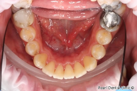 Invisalign Before After / Zoom Whitening - Lower arch teeth  