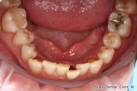 Invisalign Before After  - Lower arch teeth  