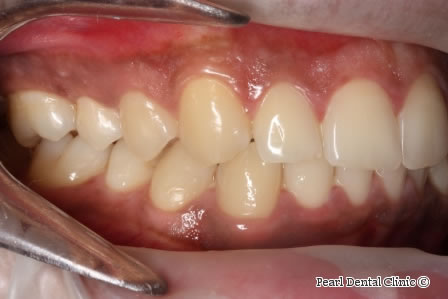 After Anterior Invisalign - Right full upper/lower arch teeth  