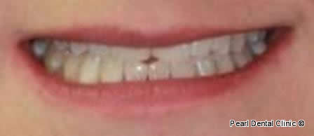 Invisalign Before After - Full smile