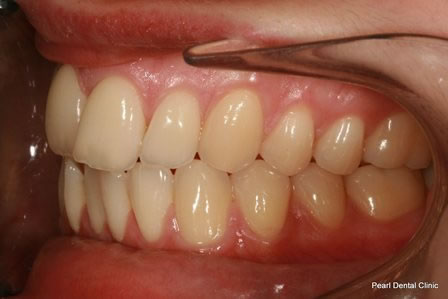 Invisalign Before After - Left full upper/lower arch teeth