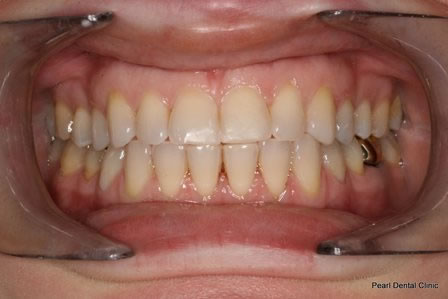 Invisalign Before After - Full upper/lower arch teeth