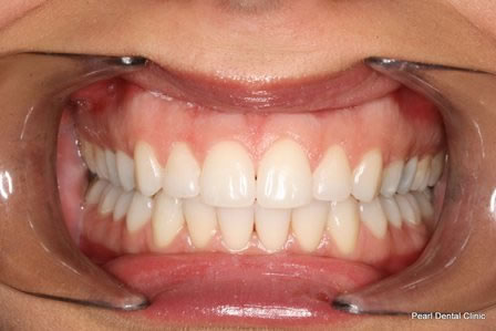 Invisalign Before After - Full upper/lower arch teeth