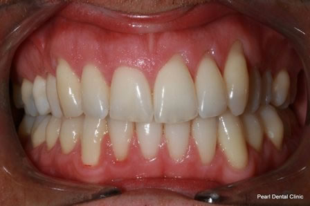 Invisalign Before After - Upper/lower arch teeth