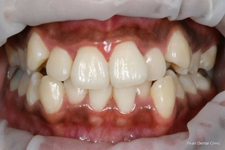 Invisalign Before After - Full upper/lower arch teeth
