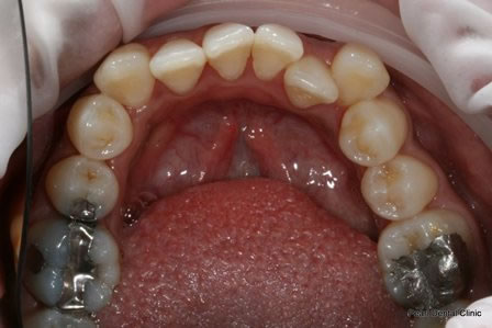 Invisalign Before After - Lower arch teeth