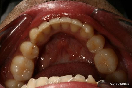 Invisalign Before After - Lower arch teeth