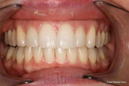 Invisalign Before After - Full upper/bottom arch teeth