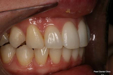 Invisalign Before After - Right full upper/bottom arch teeth