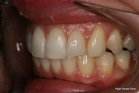 Invisalign Before After - Left full upper/bottom arch teeth