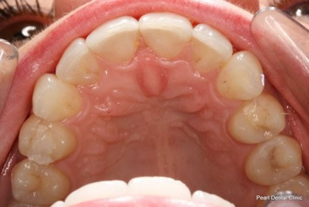 Invisalign Before After - Lower arch teeth