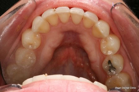 Invisalign Before After - Lower arch teeth