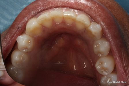 Invisalign Before After - Lower arch teeth