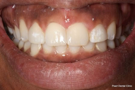 Invisalign Before After - Full upper/bottom arch teeth