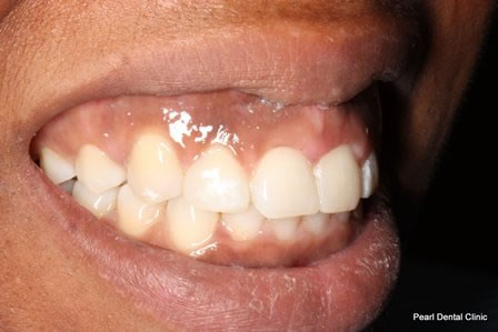 Invisalign Before After - Right full upper/bottom arch teeth