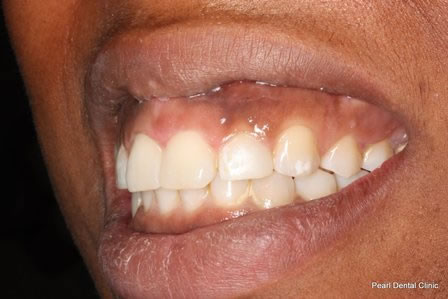 Invisalign Before After - Left full upper/bottom arch teeth