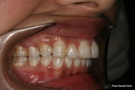 Invisalign Before After - Right full upper/bottom arch teeth