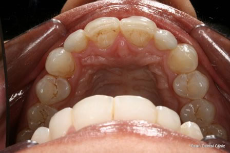 Invisalign Before After - Lower arch teeth