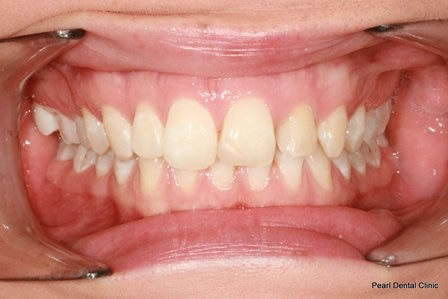 Invisalign Before After - Top/Bottom full arch teeth