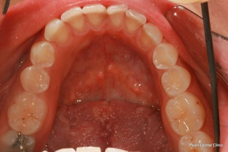 Invisalign Before After - Bottom full arch teeth
