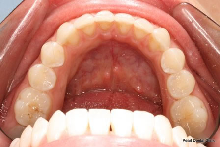 Invisalign Before After - Bottom full arch teeth