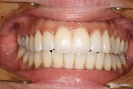 Invisalign Before After - Top/Bottom full arch teeth