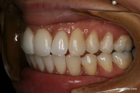 Invisalign Before After - Left top/Bottom full arch teeth