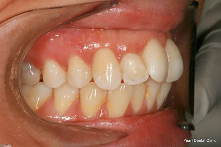Invisalign Before After - Right top/Bottom full arch teeth