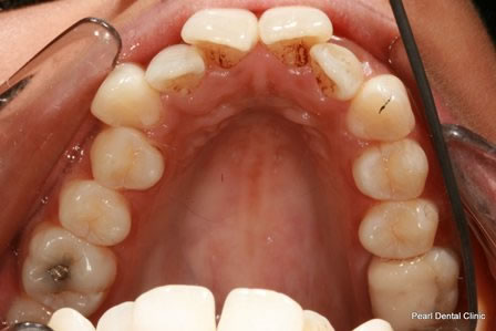 Invisalign Before After - Top full arch teeth
