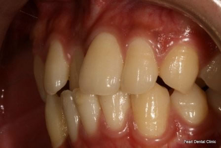 Invisalign Before After - Left top/Bottom full arch teeth