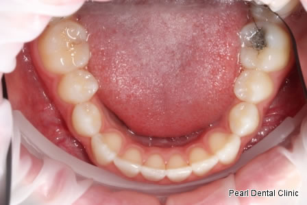 Invisalign Before After - Bottom arch teeth