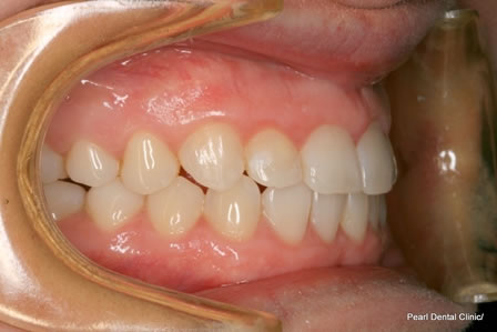 Invisalign Before After - Right full upper/lower arch teeth