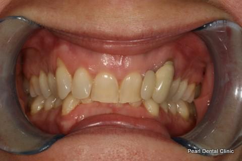 Invisalign Before After  - Full upper/lower arches teeth