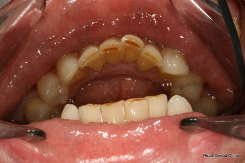 Invisalign Before After - Full lower arch teeth