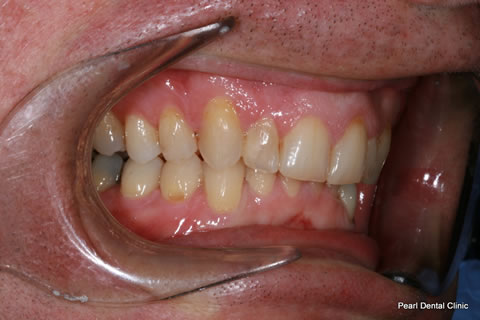 Invisalign Before After - Full upper/lower arches right side teeth