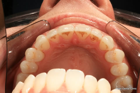 Invisalign Before After - Full top arch teeth
