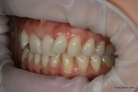 Invisalign Before After - Full upper/lower arches left side teeth