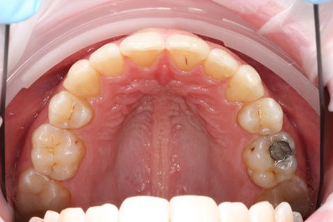Invisalign Before After - Full upper arch teeth