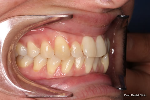 Invisalign Before After  - Full top/bottom arches right side teeth