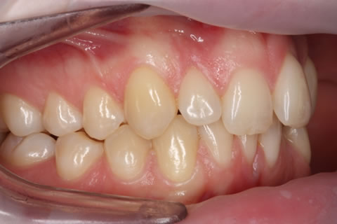Invisalign Before After - Full upper/lower arches right side teeth