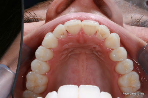 After Teeth Invisalign/ Enlighten Whitening - Upper arch teeth 