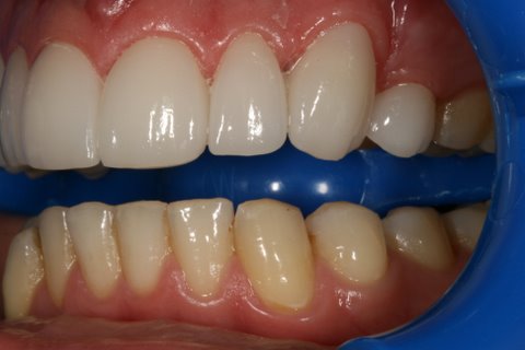 Lumineers Before After - Left full arch upper front teeth 