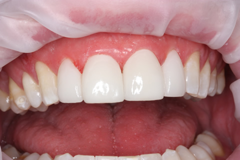 Teeth Gap Before After Closed - Upper teeth lumineers