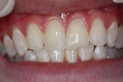 Lumineers Before After - Upper teeth appearance